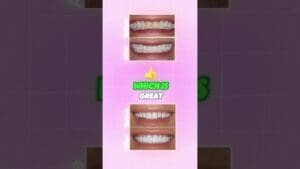 Are Clear Aligners Too Good To Be Truly Effective?