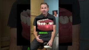 CAVITIES! What Happens When You Don’t Get a Filling?!