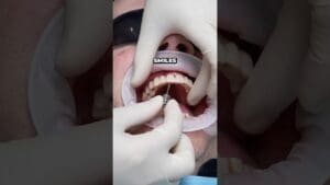 Are dental implants better than veneers???