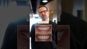 Do You Want Dental Veneers?