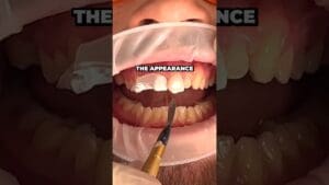 What’s The Difference Between a Crown and a Veneer?