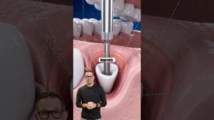 Should you replace your teeth with dental implants? Cosmetic dentist Dr. Andrew Hall explains