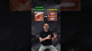 Veneers or Clear Aligners? Which is BETTER?